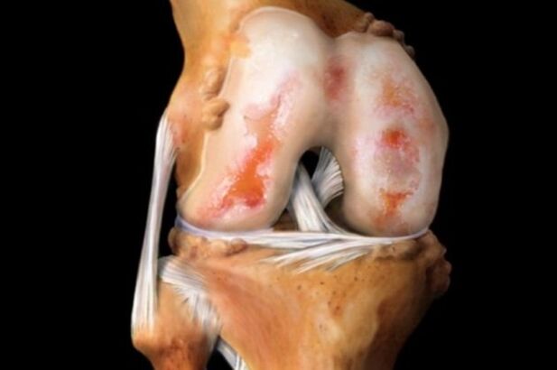 Kelio sąnario sunaikinimas dėl artrozės - dažna raumenų ir kaulų sistemos patologija