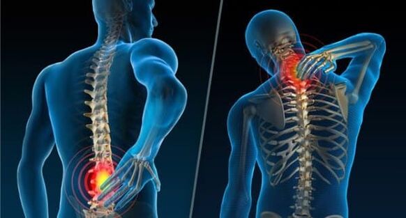 Požymiai, rodantys osteochondrozės vystymąsi – kaklo ir apatinės nugaros dalies skausmas