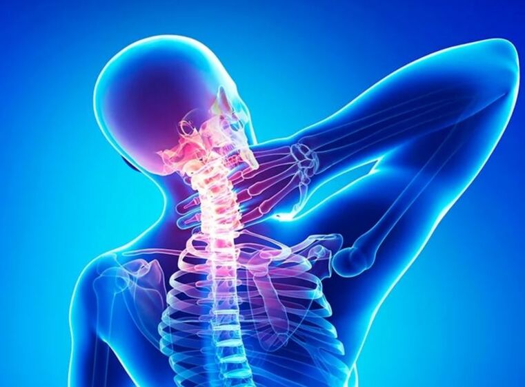 Gimdos kaklelio stuburo osteochondrozė