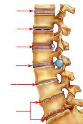 Kaip vystosi osteochondrozė