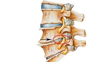 Gimdos kaklelio osteochondrozės priežastys
