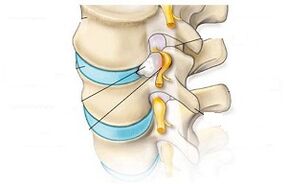 Pagrindiniai gimdos kaklelio osteochondrozės simptomai