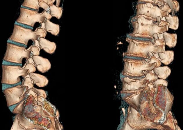 Juosmens stuburo kompiuterinė tomografija normaliomis sąlygomis ir sergant osteochondroze